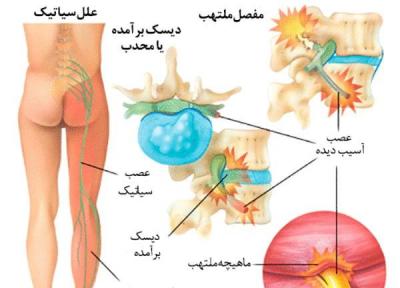 درمان درد سیاتیک با ورزش های مفید خانگی (آموزش تصویری)