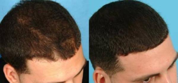 هفت روش برای داشتن موهای پر پشت هفت روش برای داشتن موهای پر پشت